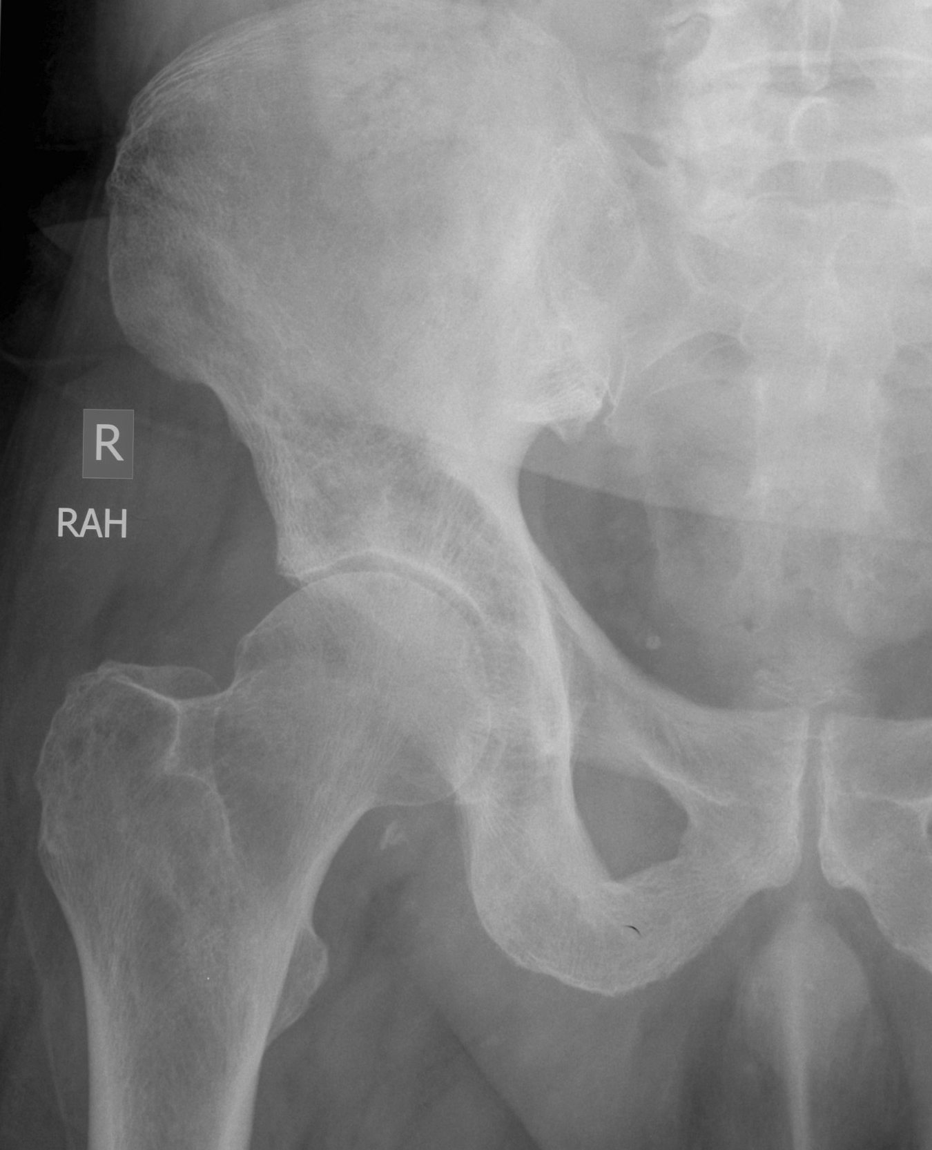 Paget's Disease The Bone School